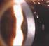 Uso de la mitomicina C en la prevención del haze corneal