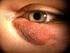 Comportamiento del Síndrome de ojo seco en el Servicio de Oftalmología Behavior of the Dry Eye Syndrome in the Ophthalmology Service