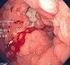 Carcinoma superficial de esófago: análisis clínico-patológico y sobrevida