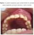 Fibroma osificante maxilar: Presentación de un caso y revisión de la literatura