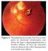 Toxoplasmosis ocular adquirida en nuestro medio. Revisión de casos