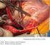 Artículo de Revision Enfermedad de tronco de la arteria coronaria izquierda y múltiples vasos. Nuevas evidencias.