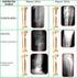Tratamiento de fracturas diafisarias cerradas de tibia con osteosíntesis interna e implantes de hidroxiapatita Coralina HAP-200