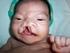 Malformaciones congénitas en recién nacidos vivos. Municipio Marianao