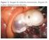 Embarazo heterotópico (presentación de caso clínico). Revisión bibliográfica