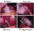Causas de conversión de la colecistectomía laparoscópica en el Hospital de Emergencias José Casimiro Ulloa,