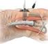 Sistema mínimamente invasivo para la extracción del tendón cuadricipital ART /2015-ES