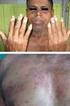 Vitiligo: clinical and epidemiological aspects
