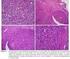 Tres casos de tumores mamarios infrecuentes: adenom ioepitel ioma, miofibroblastoma