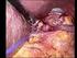 Cirugía videolaparoscópica en la hernia hiatal gigante