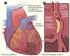 Arteriosclerosis, infartos cardíacos y apoplejías