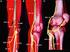 Cambios electrofisiológicos del nervio tibial en fracturas de tobillo
