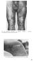 Nº 33. Extensas máculas en muslos, rodillas y piernas, acompañadas de descamación nacarada.