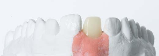 Esta reducción vestibular de carilla tiene una capa de cerámica fluorescente, que no solo le dará las propiedades ópticas naturales de la dentina, sino que también permite la adhesión de la