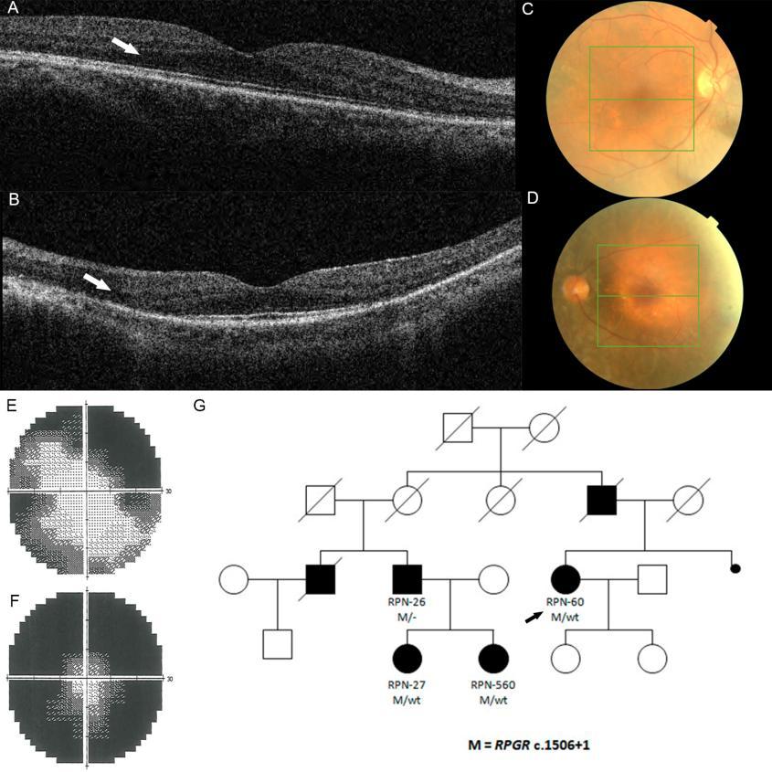Las imágenes de fondo de ojo muestran una clara degeneración retiniana asimétrica entre OD (C) y OI (D), aunque también se observa algo de degeneración retiniana cerca del disco óptico en OD.