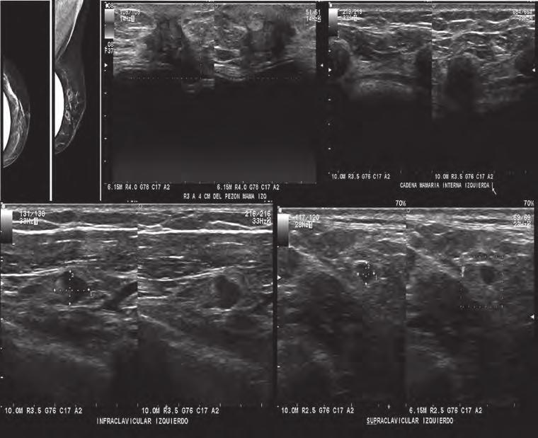 A B C D E F Figura 1. Mastografía y ultrasonido bilateral.