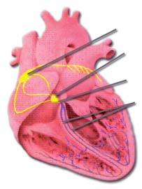 El marcapasos natural de corazón es el denominado nódulo sinusal, situado en la aurícula derecha. Produce en reposo impulsos eléctricos en torno a 70 veces por minuto.
