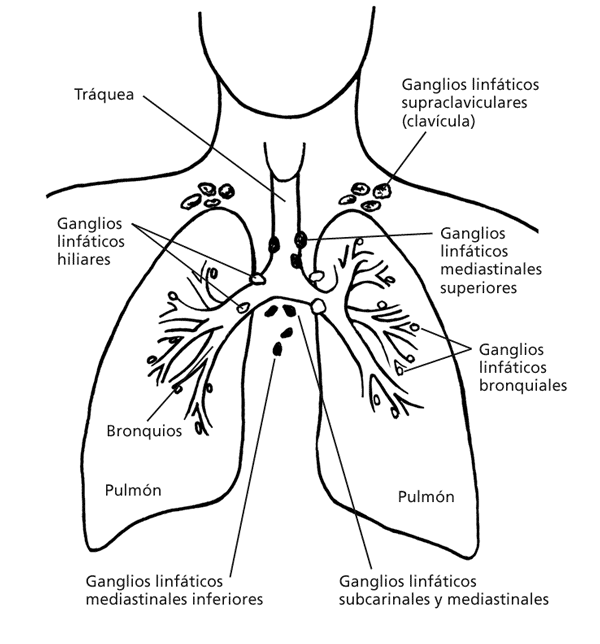 Categorías N de cáncer de pulmón NX: no se pueden evaluar los ganglios linfáticos adyacentes. N0: no hay propagación a los ganglios linfáticos adyacentes.