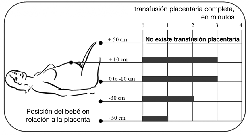 Figura 2: Importancia de la gravedad y la posición del recién nacido en la velocidad de la transfusión placentaria La figura muestra cómo la posición del bebé puede afectar el tiempo de la conclusión