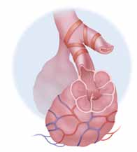 Con el tiempo, los pulmones pueden aumentar de tamaño y tener dificultades para lograr su máxima expansión en el tórax.