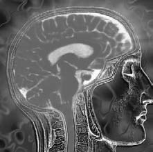 Cómo el Alzheimer afecta el cerebro Los cambios que toman lugar en el cerebro empiezan a un nivel microscópico mucho antes de las primeras señales de pérdida de memoria.