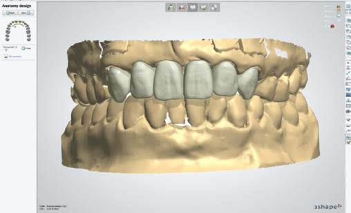 NOVEDADES EN DENTAL SYSTEM 2013 Dental System 2013 de 3Shape lleva un paso adelante la dilatada reputación de 3Shape como creadores del sistema de laboratorio para CAD/CAM dental más innovador y