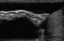 ECOGRAFÍA UTILIDAD DE LA ECOGRAFÍA EN EL ESTUDIO DEL ESCROTO Ligamento testicular, el polo inferior del testículo está unido a las envolturas extravaginales por un ligamento, que es resto del
