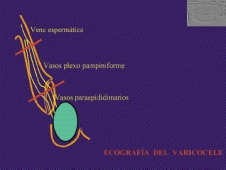 El esquema muestra los lugares de producción del varicocele. Fig. 35.
