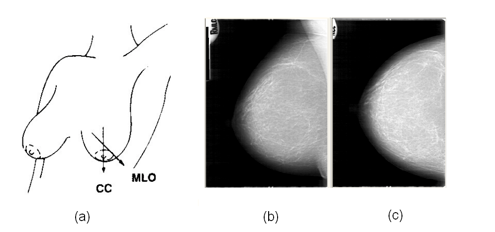 bido a que el tejido denso normal y el anormal usualmente tienen similar atenuación a los Rayos X, además existen otros factores como la calidad de la imagen, el bajo contraste y la incidencia de