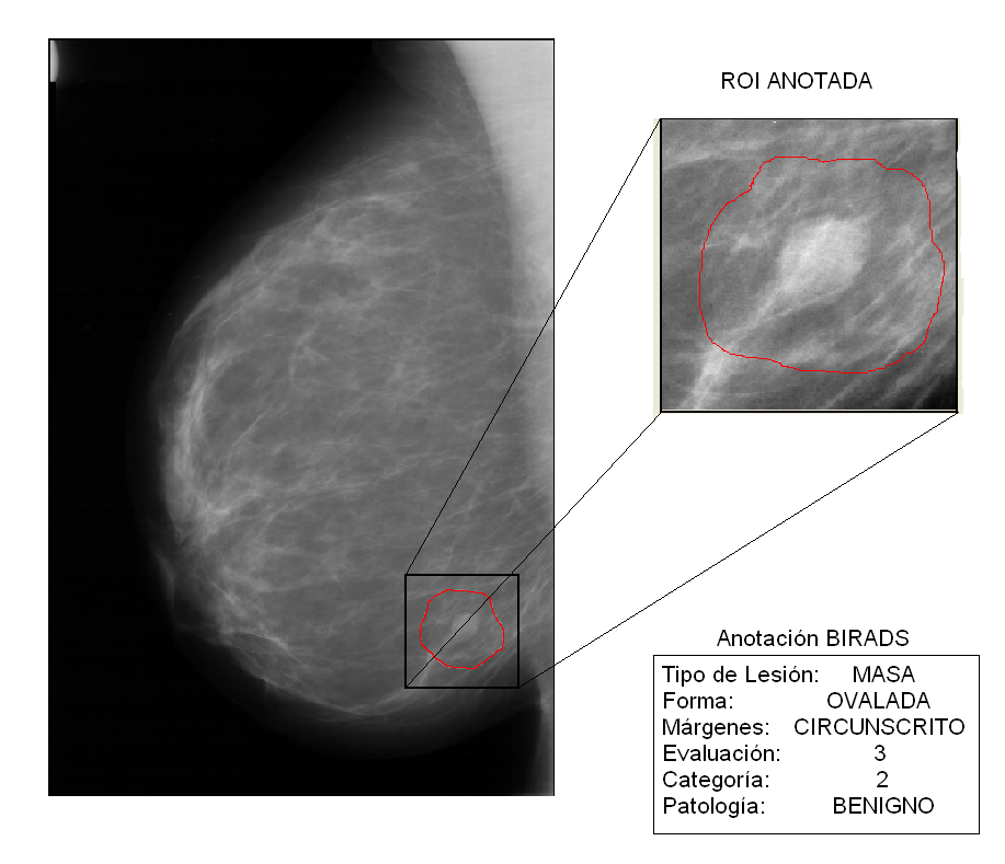 la Forma, Margen y Patología 2. La extracción de cada región se realizó utilizando información de la ubicación espacial de la anormalidad, contenida en cada mamografía de la base de datos.
