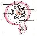 placenta (inserción velamentosa), que pueden provocar trastornos circulatorios en el feto y perturbar el desarrollo del parto.