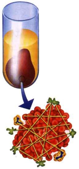 MÉTODO COAGULATIVO EN UNA ETAPA (ONE-STAGE ASSAY) Mide la capacidad del FVIII contenido en una muestra de acortar el tiempo de formación de un coágulo del plasma de un hemofílico A, tras una