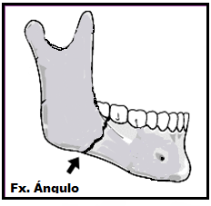 Fig. (30) Fx. Cuerpo Mandibular 2.4.4.3. Fracturas de Ángulo Mandibular Las fracturas del ángulo se localizan entre el borde anterior del músculo masetero y el tercer molar inferior. Fig.