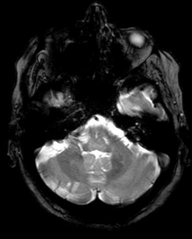 RESONANCIA MAGNETICA 18/06 T2 GRE FLAIR Lesión cortico-subcortical del hemisferio cerebeloso derecho hiperintensa en secuencias T2,