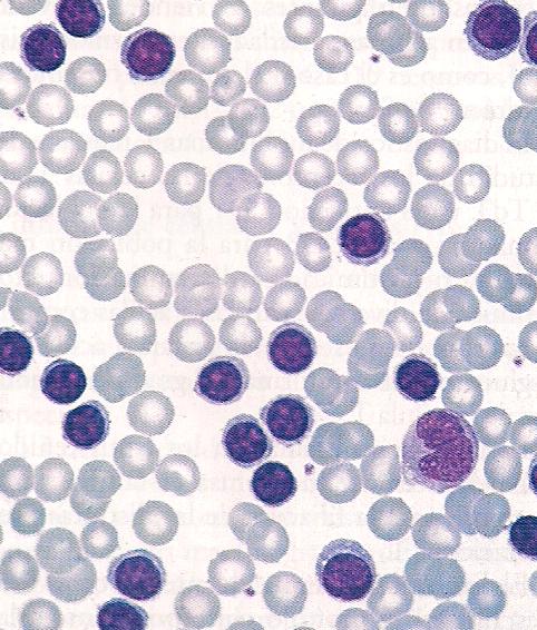 20 La detección de mutaciones en el rearreglo de genes de la región variable de la inmunoglobulina indica que este linfoma se origina en una célula B del centro germinal (43).