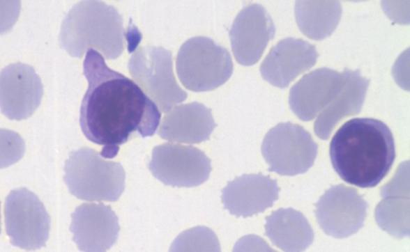31 MM: tuvo una prevalencia similar a la LPL-B (10 %). La Figura 25A muestra la citomorfología de médula ósea de un caso de MM donde se observa la morfología típica de las células plasmáticas.