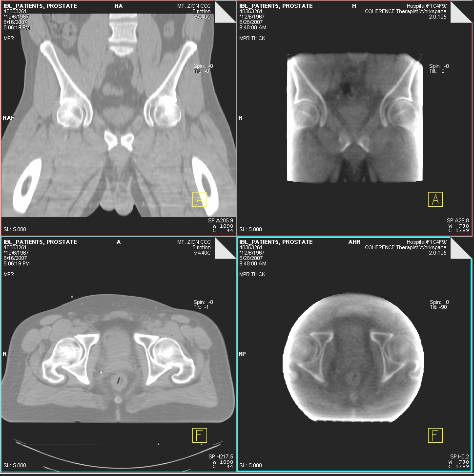 ARTISTE Imaging Beam-Line Patient #5 Pelvis Comparison to planning CT Treatment Day 1 MVCBCT acquisition at 10cGy Research data
