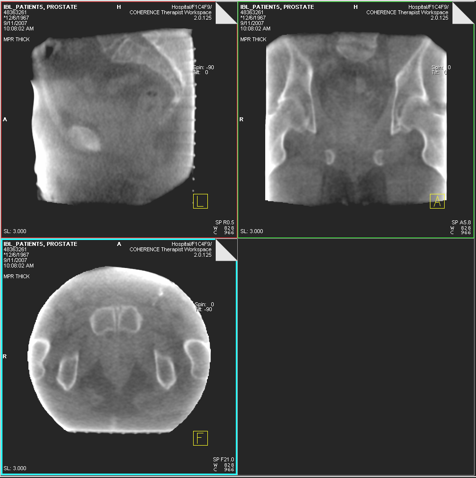 ARTISTE Imaging Beam-Line Patient #5 Pelvis MVCBCT Treatment Day 14 MVCBCT acquisition at 10cGy Research data property