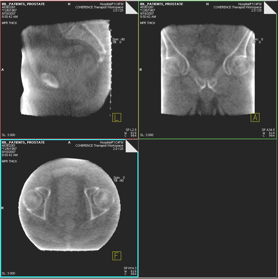 ARTISTE Imaging Beam-Line Patient #5 Pelvis MVCBCT Treatment Day 25 MVCBCT acquisition at 5cGy Research data property