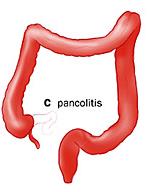 Características clínicas de la CU Extensión de la enfermedad A proctitis B colitis izquierda C pancolitis