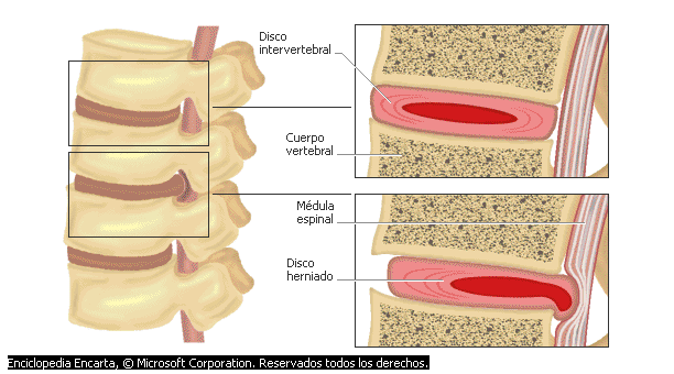 Hernia discal En la hernia o prolapso discal, el disco intervertebral se desplaza de