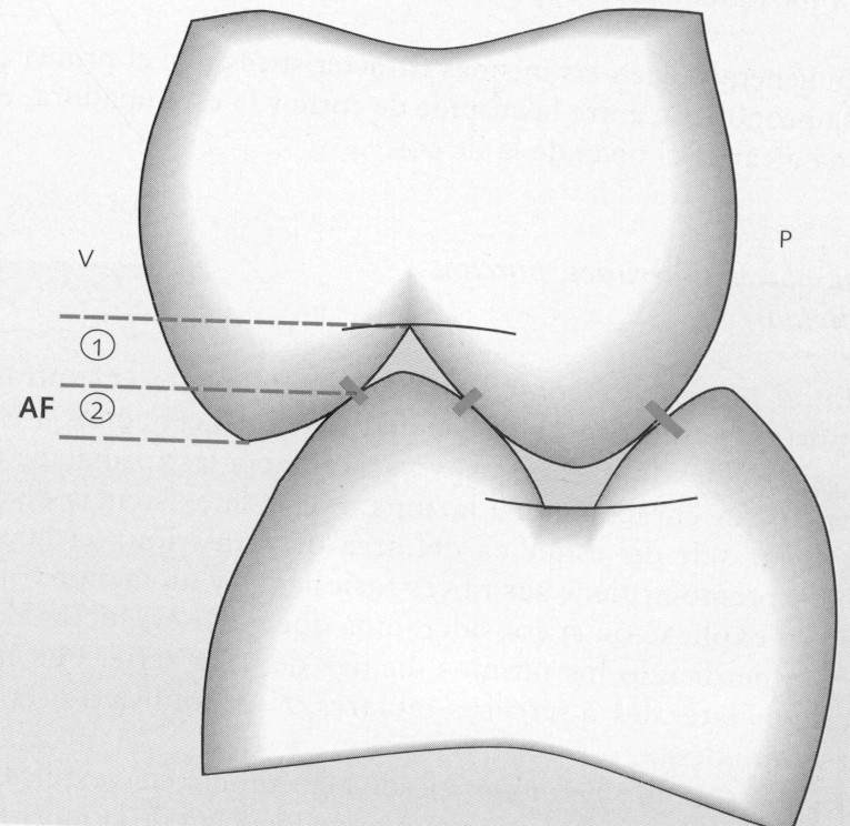 ALTURA CUSPIDEA: Es la distancia entre la cima cuspídea y una linea imaginaria perpendicular al eje axial del elemento dentario que pasa por el fondo de la fosa. (fig.