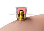 :: O ring con cilindro incluye disco de protección. :: Secuencia demostrativa del Attachment Mini Bola CM en la página 96. 32 N.