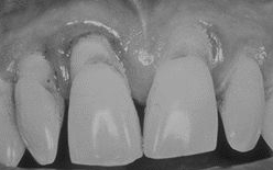 CEMENTO Composición Orgánica del Cemento Forma parte del periodonto (aparato de sostén del diente).