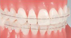 Técnica Cerámicos Otro avance de la ortodoncia es la técnica Invisalign o tratamiento Brackets Cerámicos.