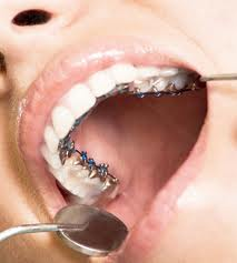 Técnica lingual La ortodoncia lingual, se caracteriza por colocarse los brackets detrás de las piezas dentales, haciendo totalmente imperceptible la aparatología.