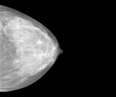 Cáncer de Mama Cáncer de Mama Diagnóstico temprano No existe prueba Programas de cribados Mamografías Exploración diagnóstica por rayos X (radiografía de la mama) Resonancia magnética Utiliza onda de
