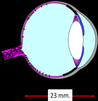 OJO HIPERMETROPE OJO EMETROPE OJO MIOPE En la ametropía refractiva (o de índice refractivo), El largo del ojo es