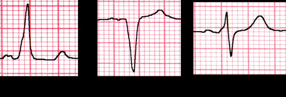 Fig.11.Esquema que muestra el método para analizar la forma del QRS en el electrocardiograma de 12 derivaciones con preexcitación. Una onda R dominante indica un complejo QRS positivo (A).