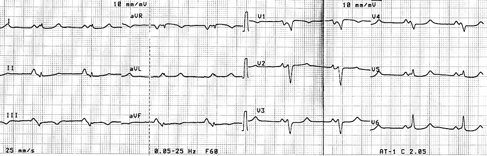 Fig.17. Electrocardiograma de 12 derivaciones en un paciente con Enfermedad de Ebstein con síndrome de preexcitación ventricular y ausencia de BRD (tomado de Iturralde P y Cols.